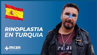 Rinoplastia en Turquía con MCAN Health [upl. by Fleurette382]