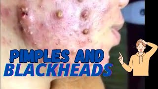 Pimples and Blackheads Removal 😲 pimple popping pimple pimplepopping blackheads [upl. by Id574]