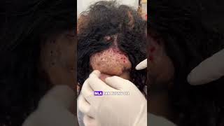 Hidradenitis suppurativa  Dr Walid [upl. by Ardnaid]