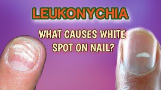 Leukonychia  what are white spot on nail [upl. by Charlot]