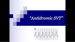 ECG Tip 21 What about quotAntidromicquot SVT [upl. by Malka167]