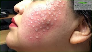 Acne Scar Treatment TCA Cross using TCA 80 [upl. by Nahtam]