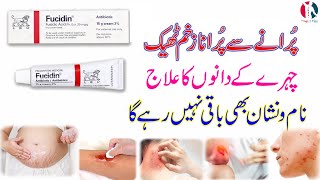 fucidin topical cream  fucidin cream  fucidin h cream uses in urdu  fucidin acid  how to use [upl. by Kathryne]