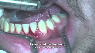 Periodontal treatment by laser [upl. by Krum]