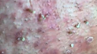 How To Remove Blackheads And Whiteheads On Face Easy 78 ✦ Dr Laelia ✦ [upl. by Eiralam]