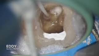 Endodontic Irrigation EDDY [upl. by Ransell140]