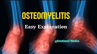 Osteomyelitis  Bone pathology  emotionalmedico [upl. by Bergeron912]