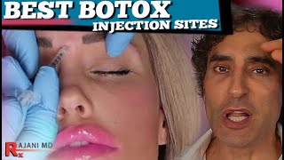 Botox Injection Sites Dr Rajani [upl. by Carberry]