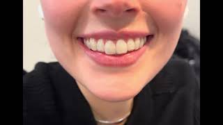 invisalign attachments are not as noticeable if they are designed favorably [upl. by Ainnek]