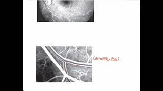 Normal Fluorescein AngiogramOphthalmology [upl. by Eerpud]