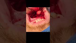 Mandible cyst removal [upl. by Lazos743]