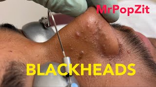 Tons of blackheads 17 minutes of extractionsBlackheads whiteheadsmilia Face and ears MrPopZit [upl. by Pren]