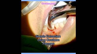 Simple Tooth Extraction using Cowhorn Forceps [upl. by Uaerraj]