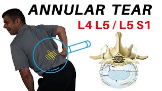 Annular Tear L4L5 L5S1 Disc Bulges [upl. by Areta]