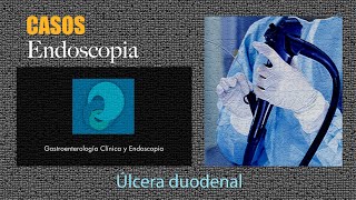 Úlcera duodenal [upl. by Heidy570]