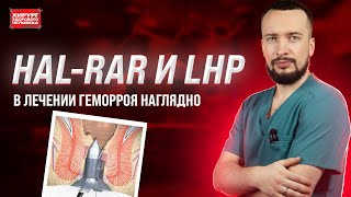 Хирургическое лечение геморроя HALRAR LHP [upl. by Aduh]