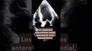 Hipoquinesia anterolateral medial y apical echocardiogram hipoquinesia akinesia infarto [upl. by Amalbena]