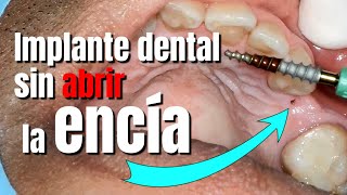 EL PROBLEMA de COLOCAR IMPLANTES SIN ABRIR la ENCÍA lo que no te dicen los dentistas [upl. by Lau]