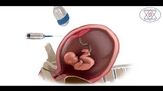 Genetic disorder diagnosis in pregnancy by Amniocentesis amp CVS Chorionic Villus Sampling [upl. by Mikeb232]