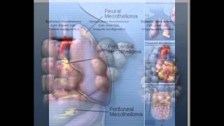 mesothelioma survival rate [upl. by Jeniece]