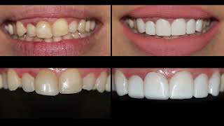 Smile Makeover Prepless porcelain dental veneers before and after cosmetic dentistry [upl. by Phaedra]