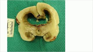 Bacterial ventriculitis in prematurity  Adventures in Neuropathology [upl. by Tiana]