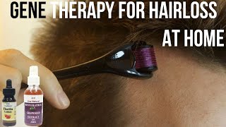 Gene therapy for hairloss at home  genetherapy hairloss hairfall [upl. by Wieche]