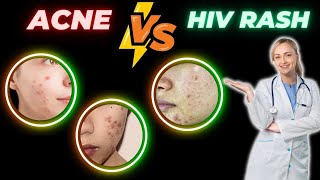 Does HIV Rash Resemble Acne [upl. by Earahs416]