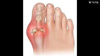 gouty arthritis and rheumatoid arthritis  osteoarthritis amp rheumatoid arthritis [upl. by Barnett700]