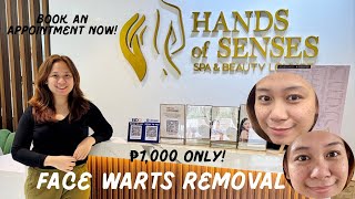 Face Warts Removal Unlimited Pin Size  Procedure  Healing Process  Road to kinis [upl. by Scheider]