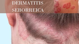 Tratamiento para la caspadermatitis seborreica l Mercí Natura [upl. by Maccarone858]