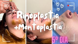 Rinoplastia  Mentoplastia  5º dia com remoção de curativo [upl. by Ludewig]