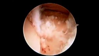 Subtalar Joint Arthroscopy Debridement SFISM [upl. by Parry286]