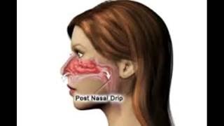 Wie zur Behandlung und Heilung post nasal drip [upl. by Laundes478]