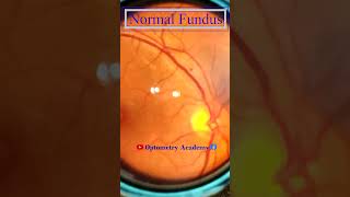 Normal fundus  Normal Retina  Smartphone Fundus Videography  Fundus Photography  Short Video 111 [upl. by Dora581]