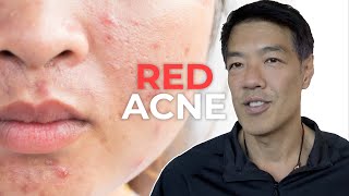 Everything about Red Acne Scars  Dr Davin Lim [upl. by Towrey]