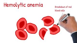 Hemolytic anemia made easy Intrinsic vs extrinsic hemolytic anemia [upl. by Asemaj]