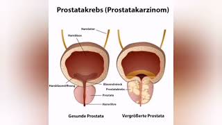 Prostatakrebs Ursachen Diagnose und Therapie [upl. by Aihsek632]