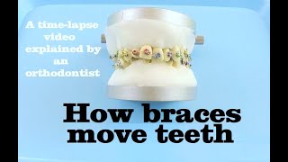 How braces move teeth timelapse  Braces Explained [upl. by Timmy256]