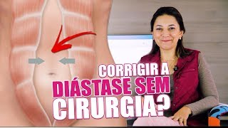 Como corrigir a diástase sem cirurgia [upl. by Lesab]