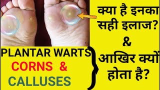 Plantar warts Corns amp Calluses Causes Symptoms amp Treatment [upl. by Kusin]