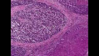 Histopathology LiverHepatocellular carcinoma in cirrhosis [upl. by Anemolihp514]