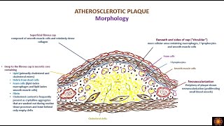 atherosclerosis morphology and consequences [upl. by Osher]