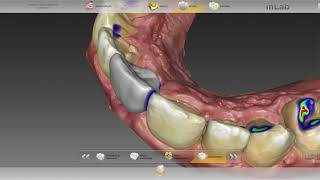 InLab 18  provisório PMMA sobre implante [upl. by Williamsen]