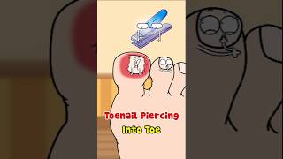 Toenail Piercing Into Toe [upl. by Nennahs]