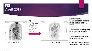 May 2020 Topics in Cardio Oncology Webinar [upl. by Nad905]