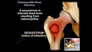 Osteomyelitis Bone Infection  Everything You Need To Know  Dr Nabil Ebraheim [upl. by Enaxor310]