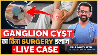 Live Ganglion Cyst Removal Case Without Surgery  Non Surgical Treatment of Ganglion Cyst [upl. by Schroeder833]