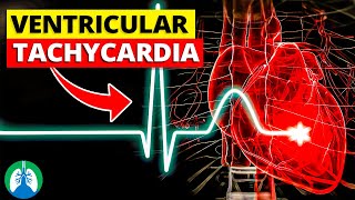 Ventricular Tachycardia Vtach  Medical Explainer Video [upl. by Lachlan]