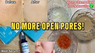 How to get Rid of Large Open Pores Best Home Remedies  Abial openpores [upl. by Ahsinaw]